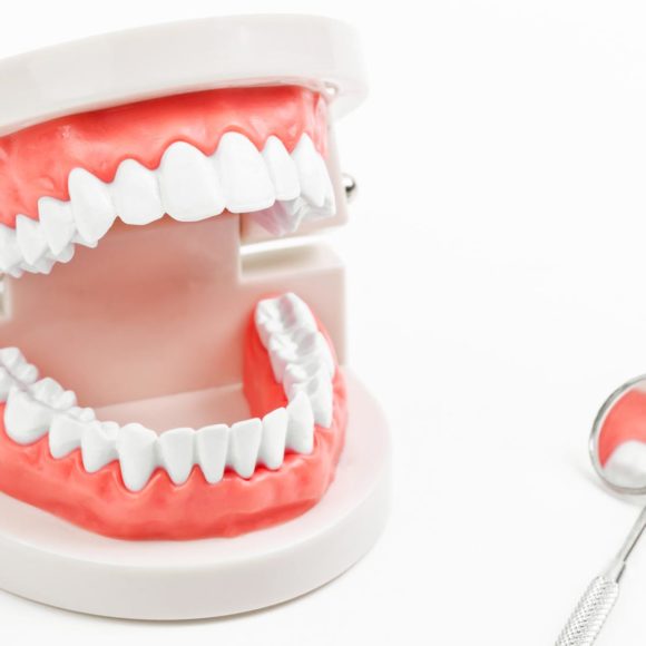 Dentures Over Implants